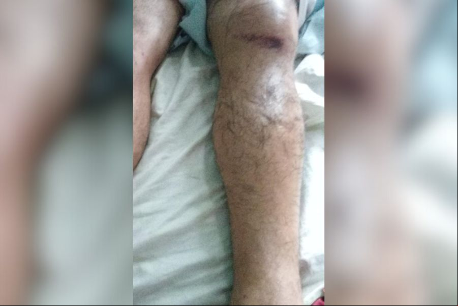 APELO: Após 16 dias de dor, exame particular revela fratura ignorada em atendimento público 